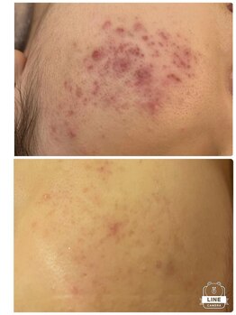 エステサロン クブ(Kubu)/ハーブピーリング×光トーニング