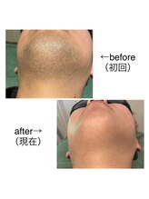 リモアボーテ(RIMOA beaute)/ヒゲ脱毛