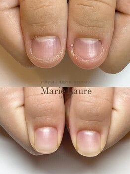 マリーロール 梅田店(Marie Laure)/自爪育成/深爪矯正/ネイルケア