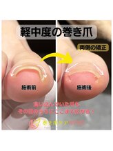 トラスト整体院 袋井院/巻き爪、陥入爪