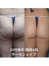 アスエ(ASUE)/エンダモロジー＋サーモシェイプ