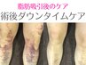 術前/術後インディバアフターケア 60分 硬さ改善/DT短縮/皮膚凸凹/色味回復
