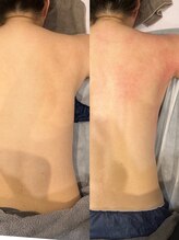 フィックスユー ビューティー(Fixyou BEAUTY)/ハイパーシリーズ before after