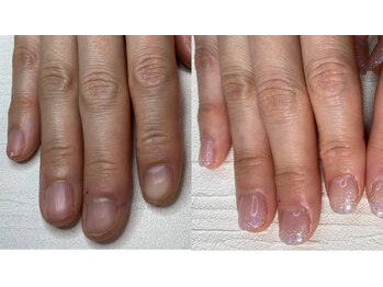 ポメロ(POMELO)/深爪矯正＋ネイルケアで血行促進