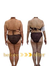 ウィッシュ(WISH)/セルライトゼロ全身痩身