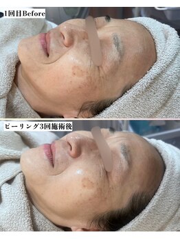 ソワナ(soina)/【神楽坂駅/フェイシャル/毛穴】