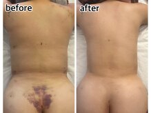 インディバジェム(GEM)/ビフォーアフター