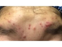 メナードフェイシャルサロン 伊那狐島/ニキビでお悩みの方必見！