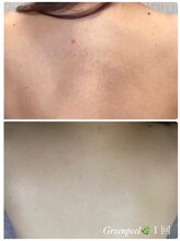 オアジスパ(Oasi Spa)/Greenpeel1回