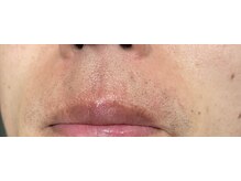 アスティ(Asti)/メンズひげ脱毛