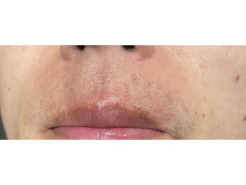 アスティ(Asti)/メンズひげ脱毛