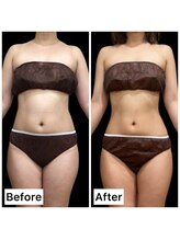 クールヴィラ(Cool Villa)/へそ上下2カップ＆サイド2カップ