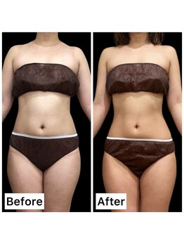 クールヴィラ(Cool Villa)/へそ上下2カップ&サイド2カップ