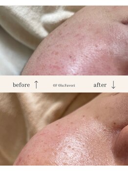 オフオルファヴォリ(OF Olu:Favori)/【フラッシュワックス脱毛】