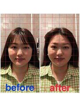 ルディア 堀江店(ledia)/美容鍼1回での変化