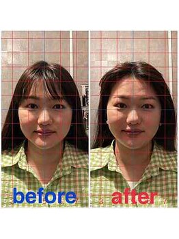 ルディア 堀江店(ledia)/美容鍼1回での変化