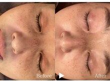 アリエルリッチ/【シミ】美肌ケアBefore→After