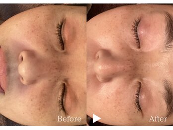 アリエルリッチ/【シミ】美肌ケアBefore→After