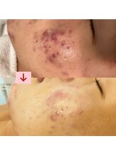 ハズキ(HAZUKI)/繰り返すニキビケアおまかせ