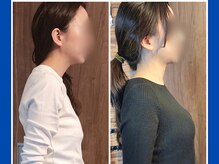 あん楽の雰囲気（巻き肩矯正の例）