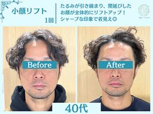 フローフシ∞/【小顔】切らない小顔リフト