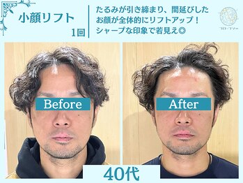 フローフシ∞/【小顔】切らない小顔リフト