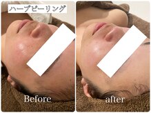 イデアルミー 大宮店(イデアルMe)の雰囲気（国産メディハーブで毛穴レス美肌へ！小顔/ハーブピーリング/毛穴）