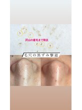 ビューティーネイル(Beauty Nail)/毛穴エクストラクション