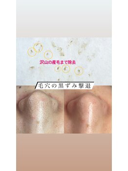 ビューティーネイル(Beauty Nail)/毛穴エクストラクション