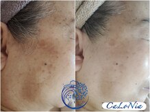 カロニア(CaLoNia)/エイジングには最強ハーブ☆