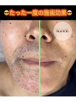 ナークス(NARX)/たった一度の施術で抜群の効果♪