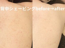 ももとゆでたまご/背中シェービングbefore→after
