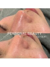 ピービー(PB)/ハイドラフェイシャル(毛穴洗浄)