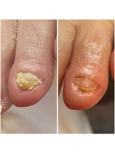 チェンジ(CHANGE)/足の小指の爪