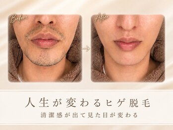シエル ブルー(Ciel Blue)の写真/都度払い◎圧倒的に第一印象を好印象に！ヒゲ脱毛でより清潔感UP！お得なクーポンもあります！
