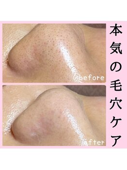 ゴールデンケア(goldencare)/本気の毛穴ケア