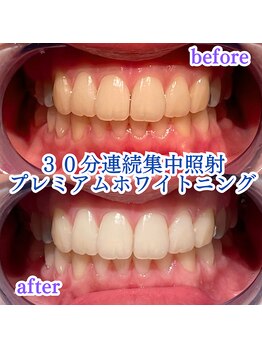 プラスビーセルフ(+b self)/30分連続照射*ホワイトニング