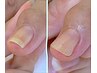 【手の巻き爪補正】　手指の巻き爪に！￥7,700～/1箇所