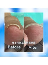 巻き爪補正店 秋葉原店/【巻き爪/陥入爪補正】