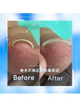 巻き爪補正店 秋葉原店/【巻き爪/陥入爪補正】