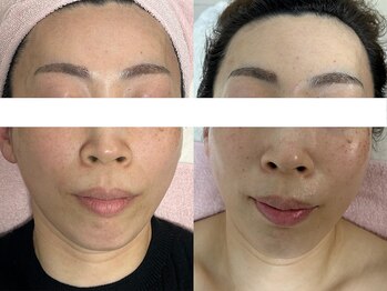 サクラ 本厚木駅前店(SAKURA)/ハーブピーリング