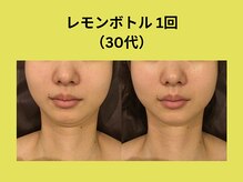 アユアランリンク 札幌店/レモンボトル/30代/1回