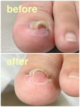 リゼラアンドコー 柏原店/巻き爪ケア！