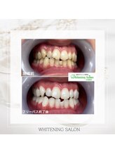 ホワイトニングサロン 名古屋駅店/【ホワイトニング施術例】