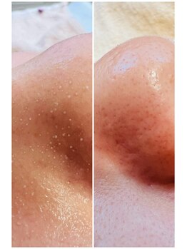 ラ メール(La mer)/銀座/新富町/ハリツヤ/毛穴洗浄