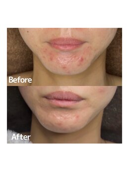 ヴィヴ フォー アール(VIV for R)/顎ニキビのお悩み改善 20代女性