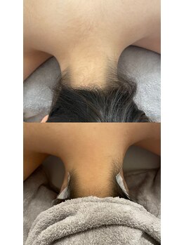 セルカ(CELCA)/うなじbefore after