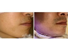 サンゴーハチ(358)/《ヒゲ脱毛》