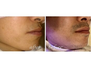 サンゴーハチ(358)/《ヒゲ脱毛》