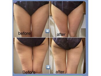 ジャスミン 新宿店(茉莉花)/ハイパーナイフキャビ太もも施術